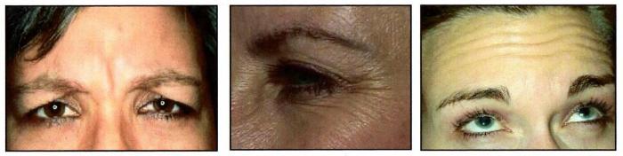 Botox- Vistabex Prima e Dopo per la parte superiore del viso