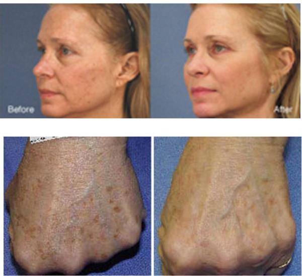 Titan Laser Before & After Pictures - Face and Hands