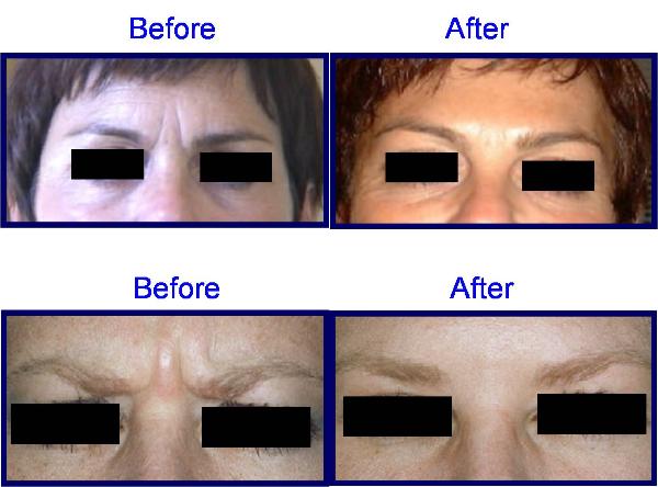 BOTOX Before & After Pictures - Frown Lines, Forehead Worry Lines, Brow Lift