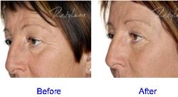 Restylane Before & After for Periorbital Lines