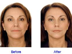 Dermal Fillers Before & After for Fine Lines in the Face