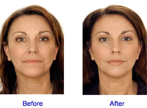 Restylane, Juvederm, and Perlane Before & After - Face Area