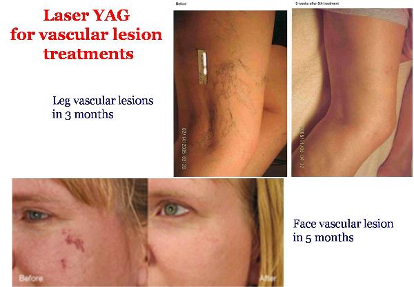Titan Laser YAG  Before & After Vascular Lesion Treatments