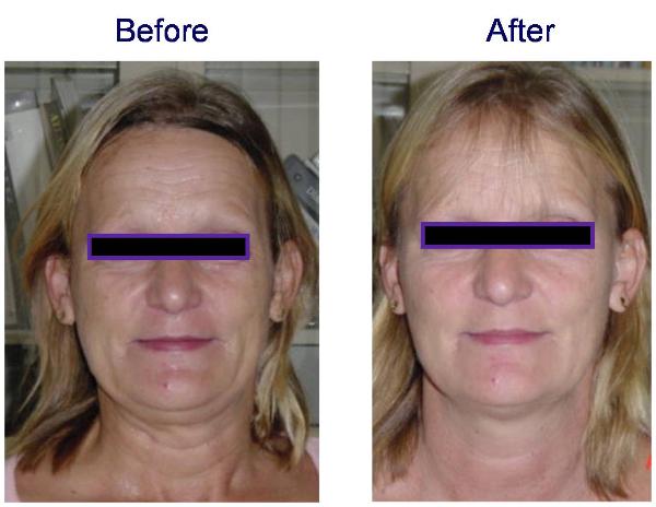 Titan Laser Before and After - Face & Neck